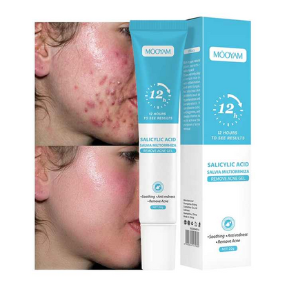 Acne Gel Remover